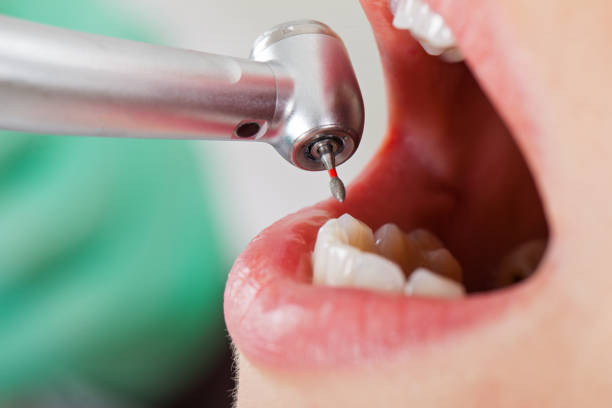 Best Dental Abscess Treatment in Parkersburg, WV